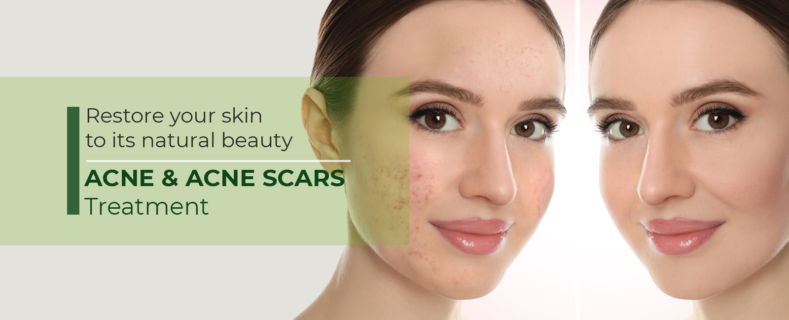 ACNE-SCARS-cover