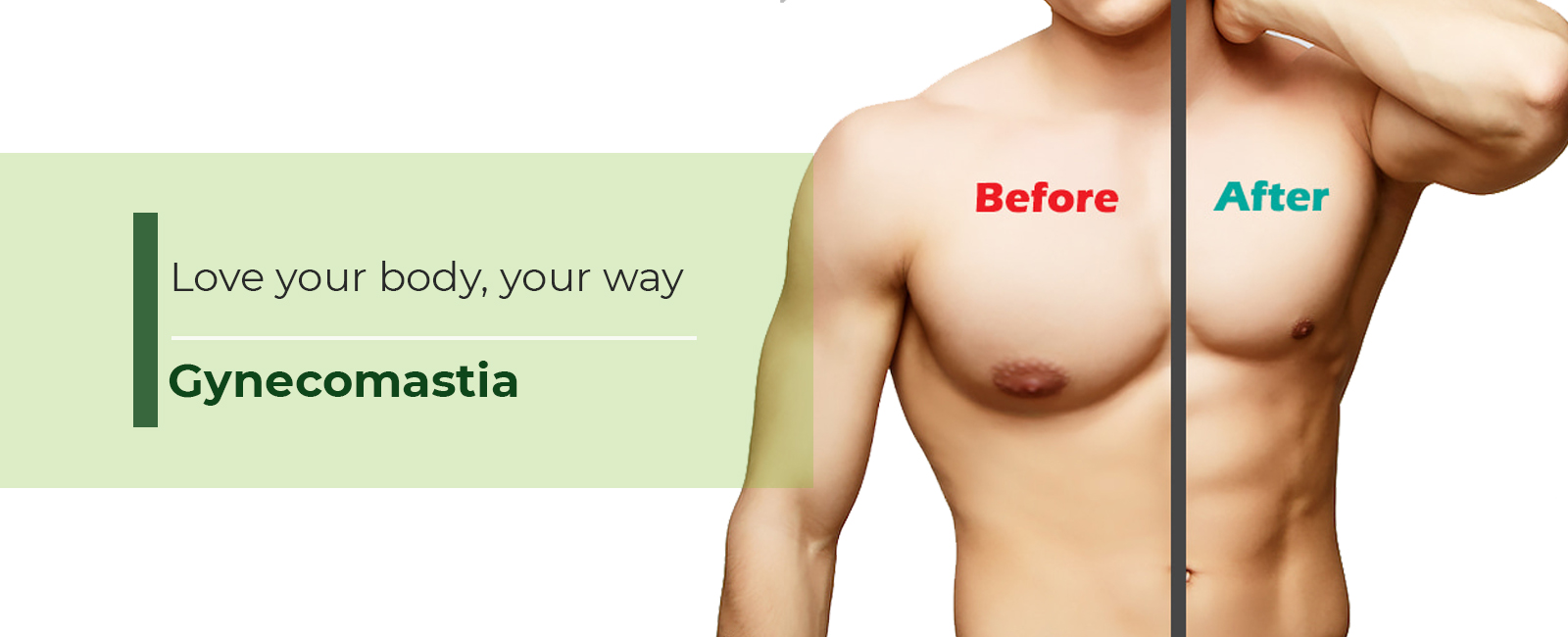 Gynecomastia​-banner