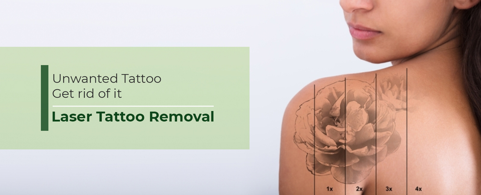 Tattoo-Removal